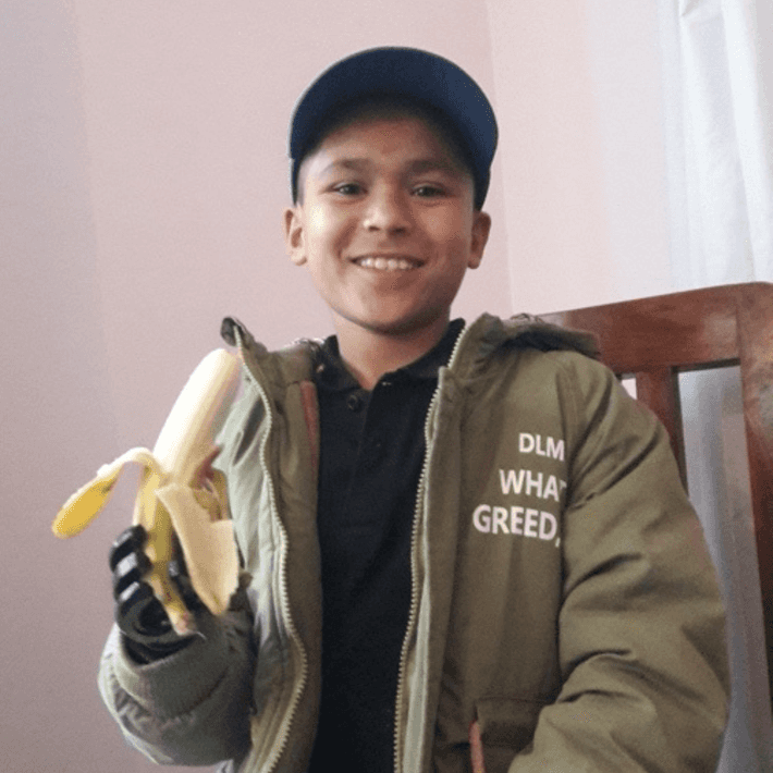 kid holding a banana with his new prosthetic arm 